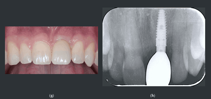 teeth xray